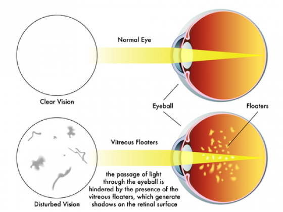 diagram explaining Eye floaters